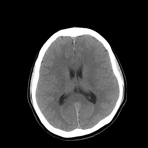 File:Neurofibromatosis type 2 (Radiopaedia 25389-25637 Axial non-contrast 15).jpg