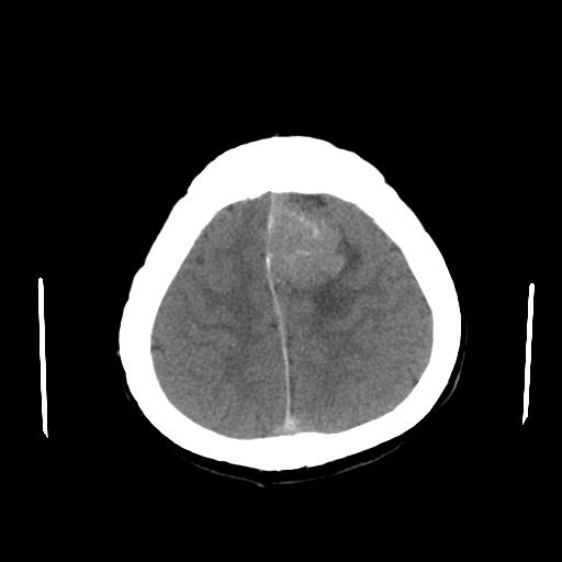 File:Neurofibromatosis type 2 (Radiopaedia 25389-25637 Axial non-contrast 22).jpg