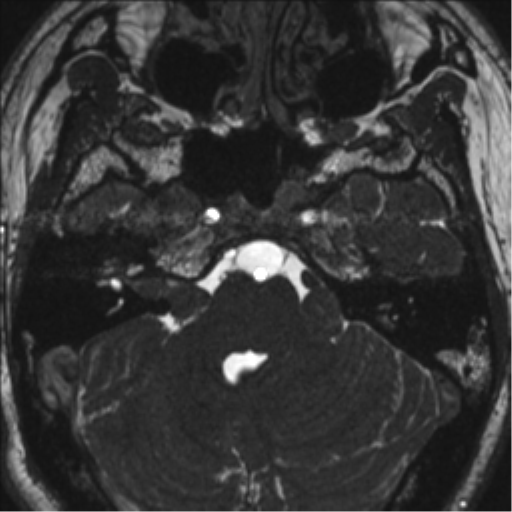 Neurofibromatosis type 2 (Radiopaedia 44936-48838 E 31).png