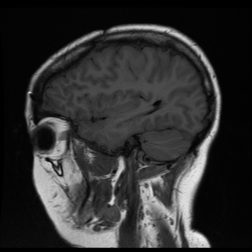 File:Neurofibromatosis type 2 (Radiopaedia 45229-49251 Sagittal T1 5).png