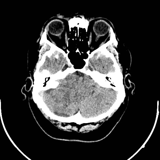 Neurofibromatosis type 2 (Radiopaedia 79097-92047 Axial non-contrast 12).jpg