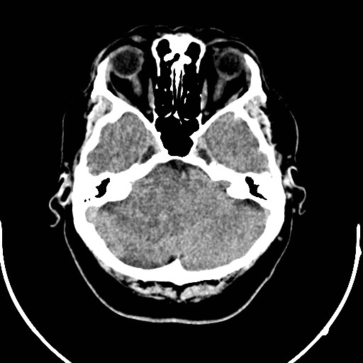 Neurofibromatosis type 2 (Radiopaedia 79097-92047 Axial non-contrast 13).jpg