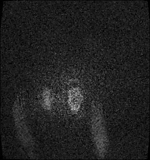 Neurofibromatosis type 2 (Radiopaedia 79097-92049 Axial T1 C+ 198).jpg