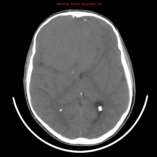 File:Neurofibromatosis type 2 (Radiopaedia 8953-9732 Axial non-contrast 19).jpg