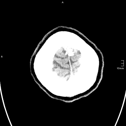 File:Neurotoxoplasmosis - concentric target sign (Radiopaedia 70644-80783 Axial non-contrast 39).jpg