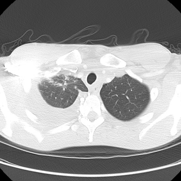 File:Non-Hodgkin lymphoma involving lung (Radiopaedia 29094-29470 Axial lung window 15).jpg
