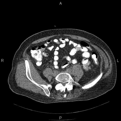 File:Non Hodgkin lymphoma in a patient with ankylosing spondylitis (Radiopaedia 84323-99624 Axial non-contrast 51).jpg