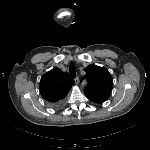 File:Non Hodgkin lymphoma in a patient with ankylosing spondylitis (Radiopaedia 84323-99624 Axial non-contrast 9).jpg