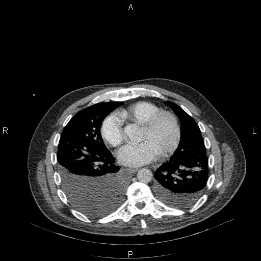 File:Non Hodgkin lymphoma in a patient with ankylosing spondylitis (Radiopaedia 84323-99624 B 18).jpg