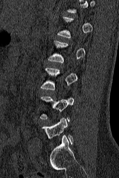 File:Normal CT lumbar spine (Radiopaedia 53981-60118 Sagittal bone window 68).jpg