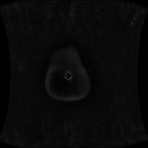 Normal MRI abdomen in pregnancy (Radiopaedia 88001-104541 M 11).jpg