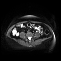 Normal MRI abdomen in pregnancy (Radiopaedia 88005-104548 Axial DWI 34).jpg