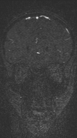 Normal MRI brain with MRV- teenager (Radiopaedia 49425-54553 Coronal MRV 82).jpg