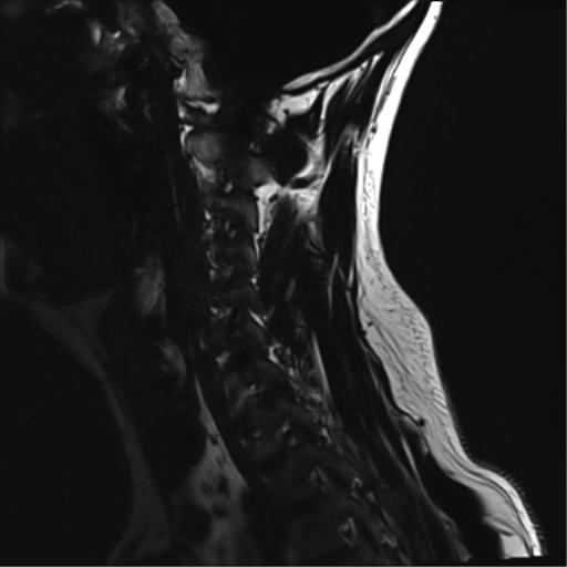 File:Normal MRI cervical spine (infection protocol) (Radiopaedia 53916-60039 F 13).png
