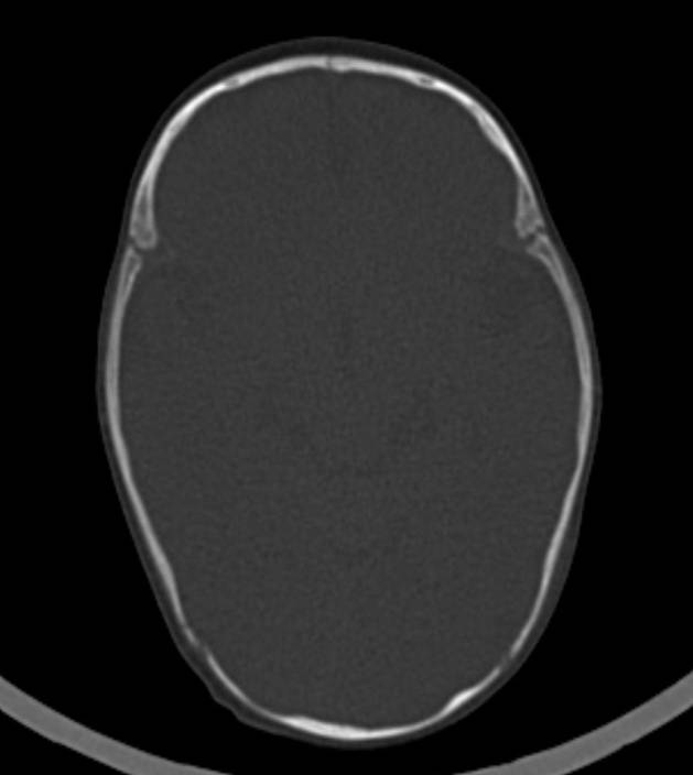 Normal brain CT - 2-month-old (Radiopaedia 53369-59350 Axial bone window 36).jpg