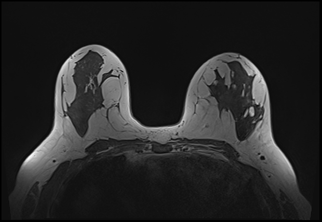 File:Normal breast MRI - dense breasts (Radiopaedia 80454-93850 Axial T1 114).jpg