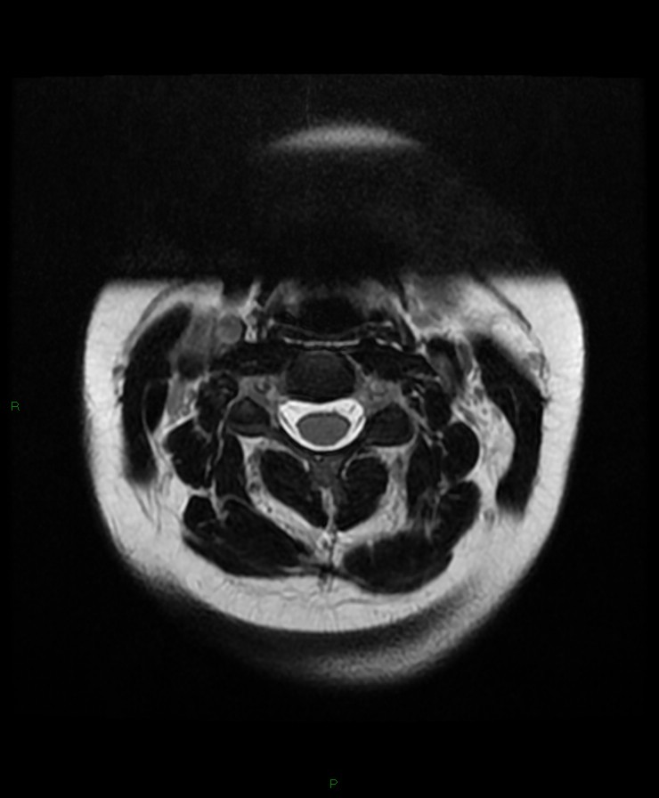 Normal cervical spine MRI (Radiopaedia 80146-93454 Axial T2 27).jpg