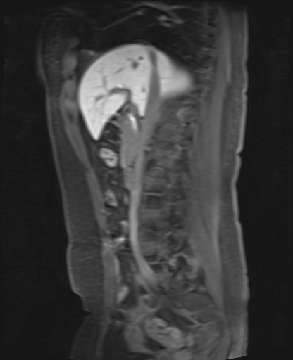 File:Normal hepatobiliary phase liver MRI (Radiopaedia 58968-66230 C 34).jpg