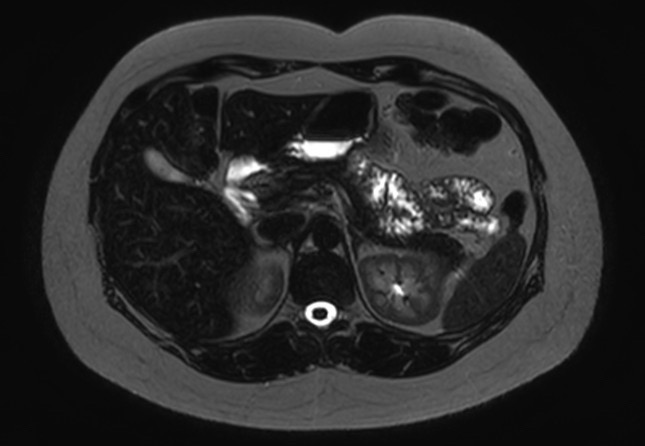 File:Normal liver MRI with Gadolinium (Radiopaedia 58913-66163 E 19).jpg