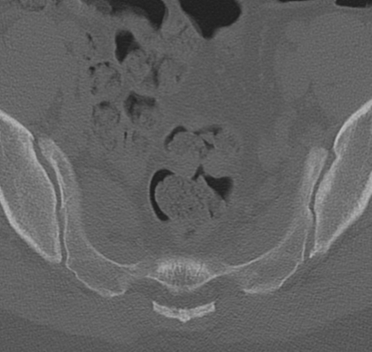 File:Normal lumbar spine CT (Radiopaedia 46533-50986 Axial bone window 80).png