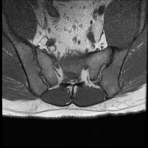 File:Normal lumbar spine MRI (Radiopaedia 35543-37039 Axial T1 1).png