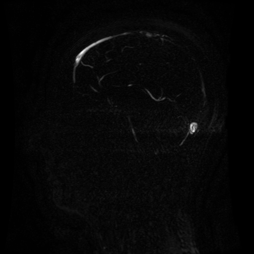 Normal noncontrast MR venography (Radiopaedia 87578-103957 A 84).jpg