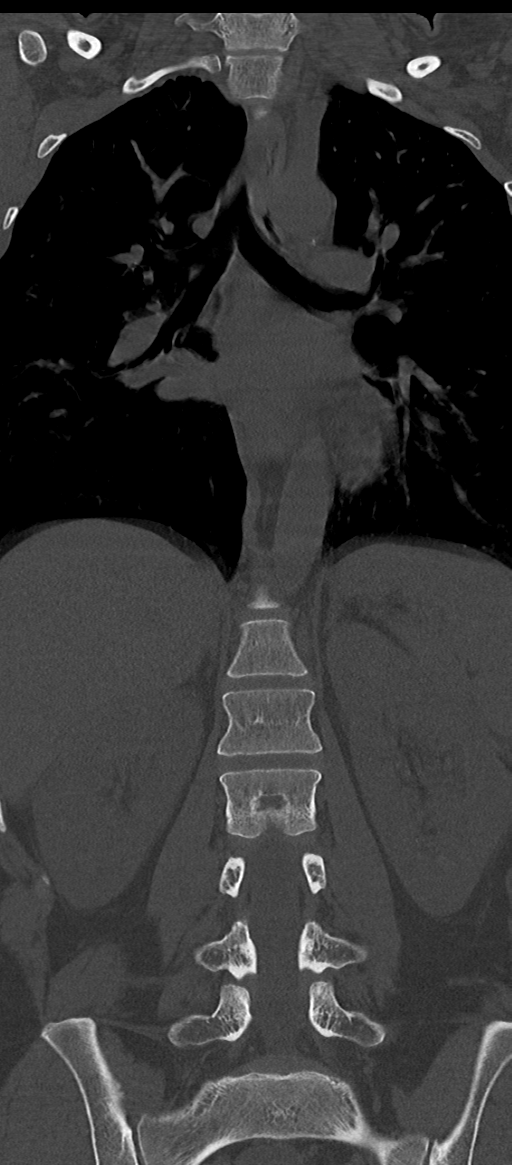Normal thoracolumbar spine (Radiopaedia 43822-47309 Coronal bone window 44).png