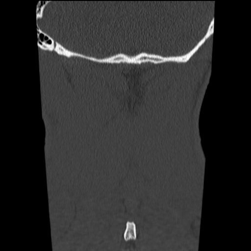 File:Normal trauma cervical spine (Radiopaedia 41017-43760 Coronal bone window 45).png