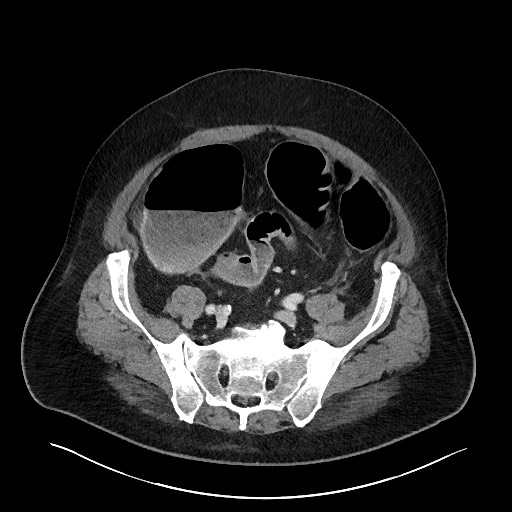 Obstructing sigmoid adenocarcinoma (Radiopaedia 58465-65619 A 123).jpg