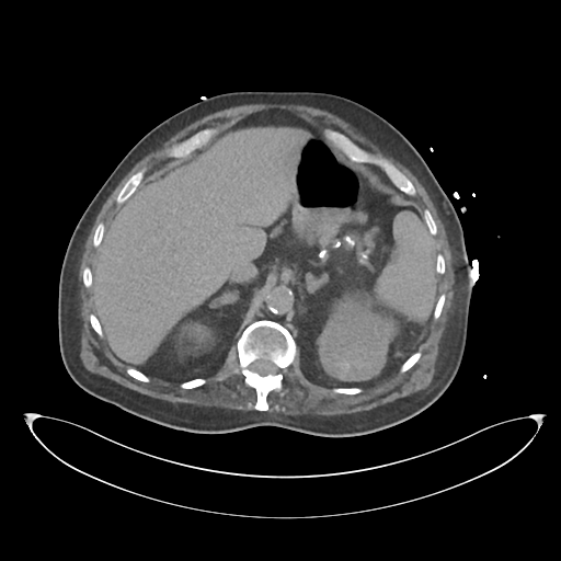File:Obstructive pyelonephritis (Radiopaedia 46411-50844 Axial non-contrast 23).png