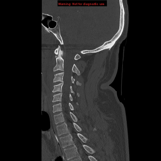 File:Occipital condyle fracture (Radiopaedia 18366-18208 Sagittal bone window 21).jpg