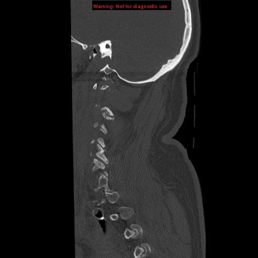 File:Occipital condyle fracture (Radiopaedia 18366-18208 Sagittal bone window 4).jpg
