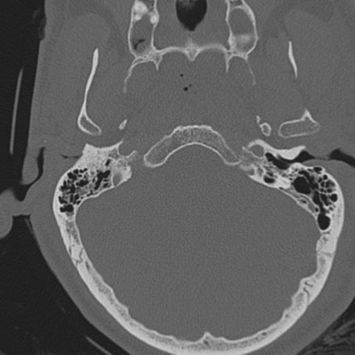 File:Occipital condyle fracture (Radiopaedia 33467-34517 Axial bone window 9).png