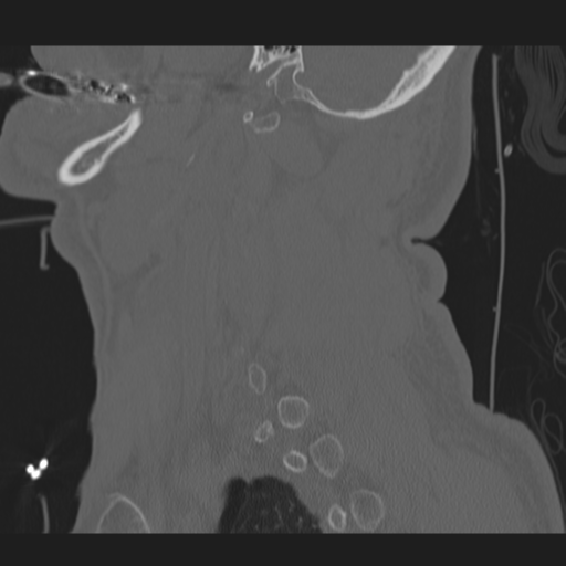 File:Occipital condyle fracture (Radiopaedia 33467-34517 Sagittal bone window 58).png