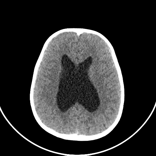 Occipital encephalocele (Radiopaedia 87339-103636 Axial non-contrast 54).jpg