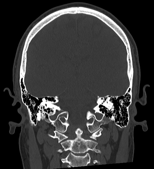 Occipital spur and Currarino type A atlas anomaly (Radiopaedia 87027-103285 Coronal bone window 92).jpg