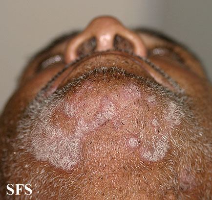 File:Psoriasis (Dermatology Atlas 42).jpg