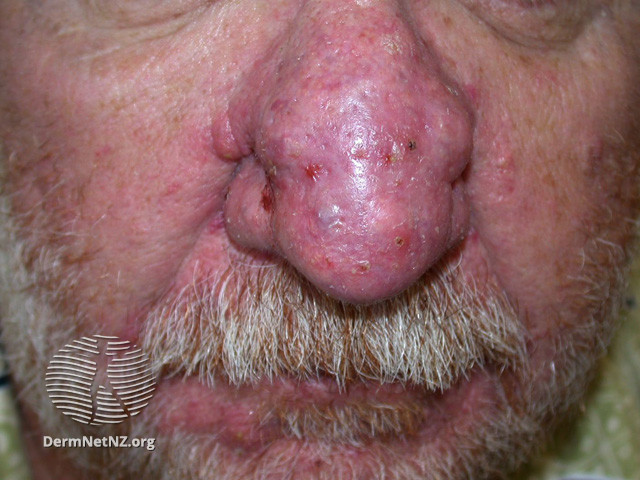 Rosacea (DermNet NZ acne-red-face-3647).jpg