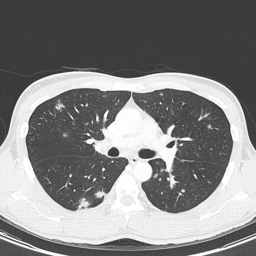 AIDS-related Kaposi sarcoma (Radiopaedia 85247-100811 Axial lung window 69).jpg