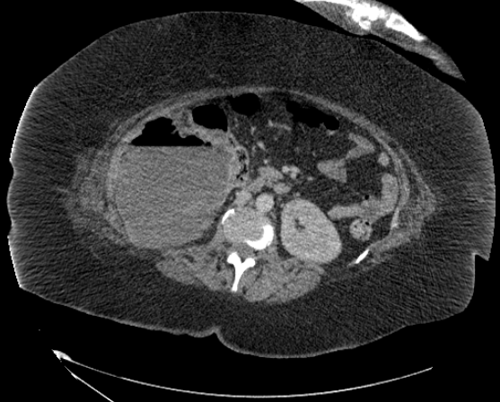 File:Abdominal abscess - pre and post percutaneous drainage (Radiopaedia 60209-67816 Axial 15).png