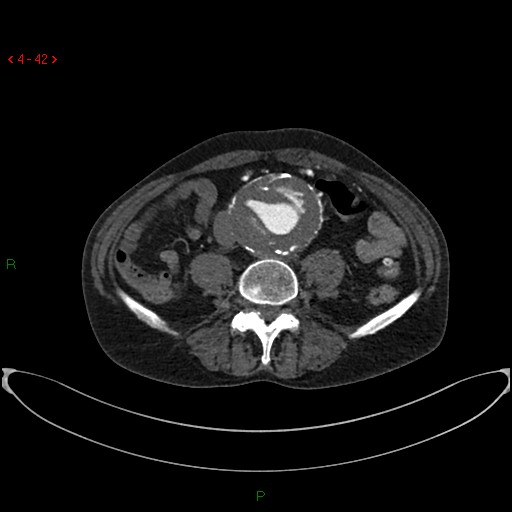 File:Abdominal aortic aneurysm (Radiopaedia 16155-15834 Axial C+ arterial phase 22).jpg