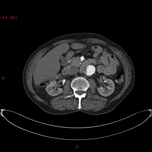 File:Abdominal aortic aneurysm (Radiopaedia 16155-15834 Axial C+ arterial phase 8).jpg