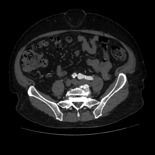 File:Abdominal aortic aneurysm (Radiopaedia 57318-64259 Axial C+ arterial phase 51).jpg