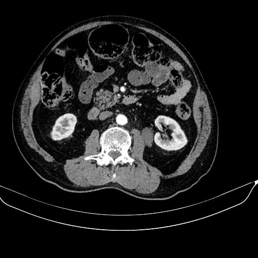 Abdominal aortic aneurysm (Radiopaedia 67117-76452 Axial C+ arterial phase 65).jpg