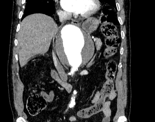 Abdominal aortic aneurysm (Radiopaedia 67117-76452 Coronal C+ arterial phase 43).jpg
