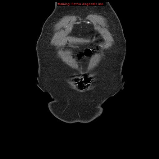 Abdominal aortic aneurysm (Radiopaedia 8190-9038 Coronal C+ arterial phase 7).jpg