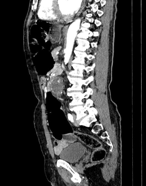 Abdominal aortic aneurysm (Radiopaedia 83581-98689 Sagittal C+ arterial phase 58).jpg