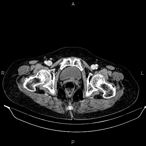 File:Abdominal aortic aneurysm (Radiopaedia 85063-100606 Axial C+ portal venous phase 65).jpg