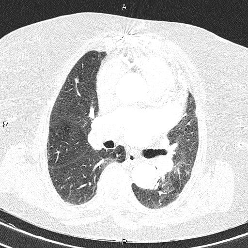 File:Abdominal aortic aneurysm (Radiopaedia 85063-100606 Axial lung window 33).jpg