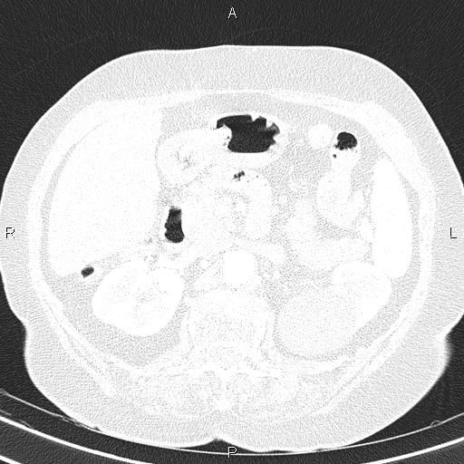 Abdominal aortic aneurysm (Radiopaedia 85063-100606 Axial lung window 70).jpg